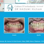 Cas clinique de traitment orthodontique du dr naoumi orthodontiste rabat