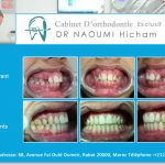 Cas clinique de traitment orthodontique du dr naoumi orthodontiste rabat