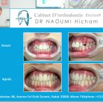 Cas clinique de traitment orthodontique du dr naoumi orthodontiste rabat