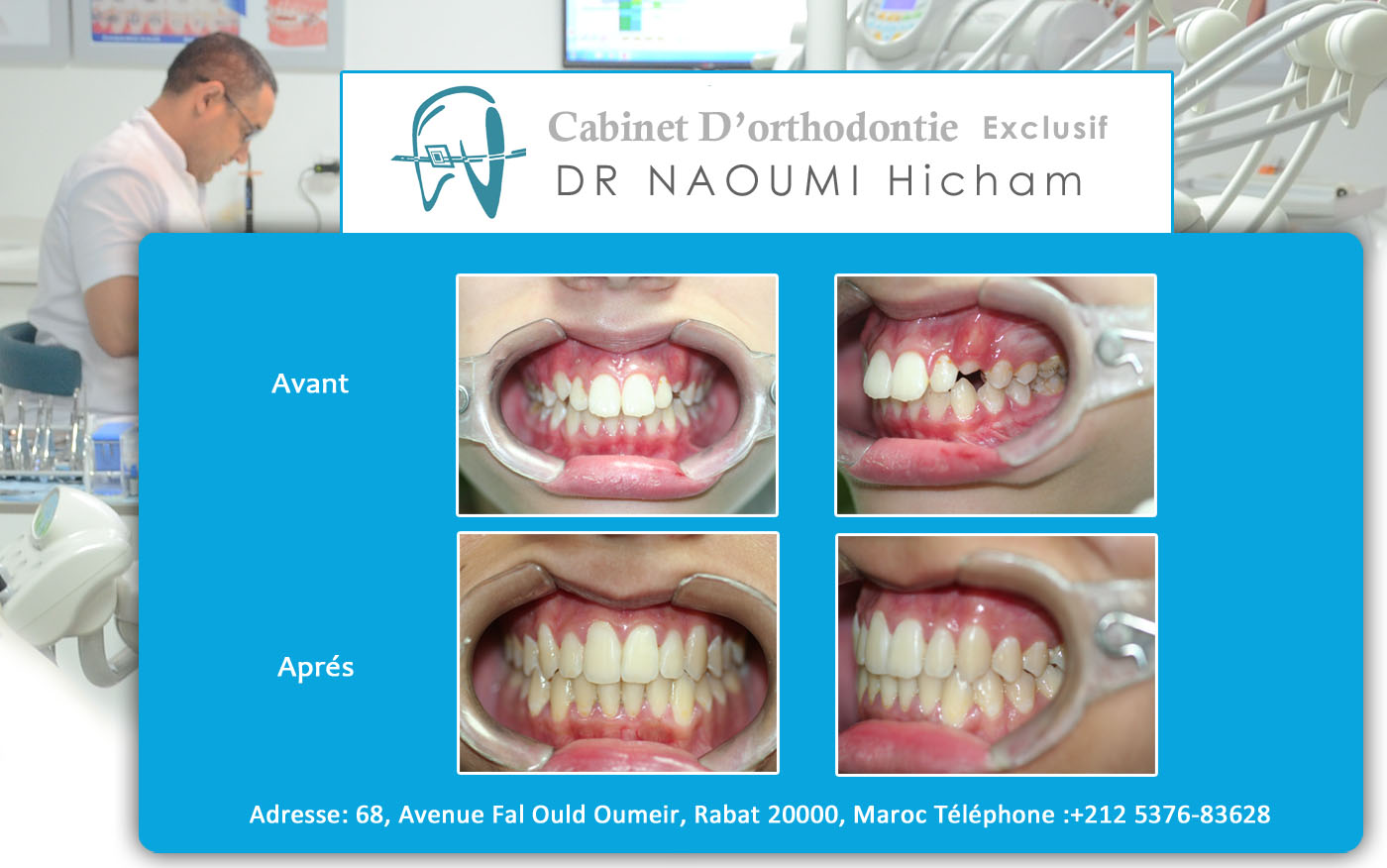 Cas clinique de traitment orthodontique du dr naoumi orthodontiste rabat