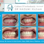 Cas clinique de traitment orthodontique du dr naoumi orthodontiste rabat