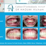 Cas clinique de traitment orthodontique du dr naoumi orthodontiste rabat
