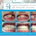 Cas clinique de traitment orthodontique du dr naoumi orthodontiste rabat