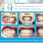 Cas clinique de traitment orthodontique du dr naoumi orthodontiste rabat