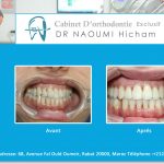 Cas clinique de traitment orthodontique du dr naoumi orthodontiste rabat