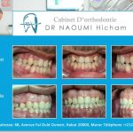 Cas clinique de traitment orthodontique du dr naoumi orthodontiste rabat