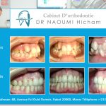 Cas clinique de traitment orthodontique du dr naoumi orthodontiste rabat