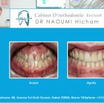 Cas clinique de traitment orthodontique du dr naoumi orthodontiste rabat