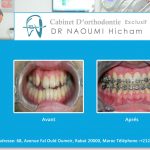 Cas clinique de traitment orthodontique du dr naoumi orthodontiste rabat