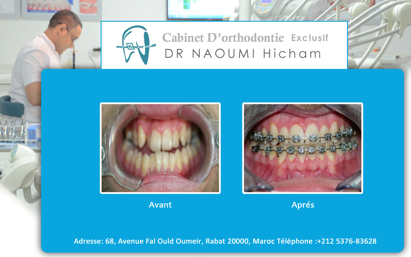 Cas clinique de traitment orthodontique du dr naoumi orthodontiste rabat