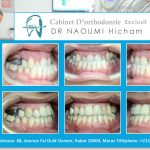 Cas clinique de traitment orthodontique du dr naoumi orthodontiste rabat