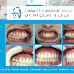 Cas clinique de traitment orthodontique du dr naoumi orthodontiste rabat