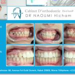 Cas clinique de traitment orthodontique du dr naoumi orthodontiste rabat